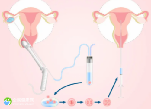 取卵手术前夜不可忽视的七项关键准备步骤